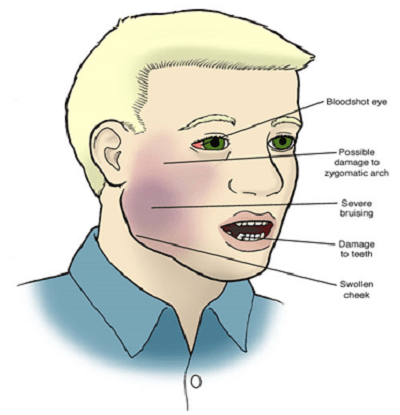 Tổng Hợp Thông Tin Về Sưng 1 Bên Hàm