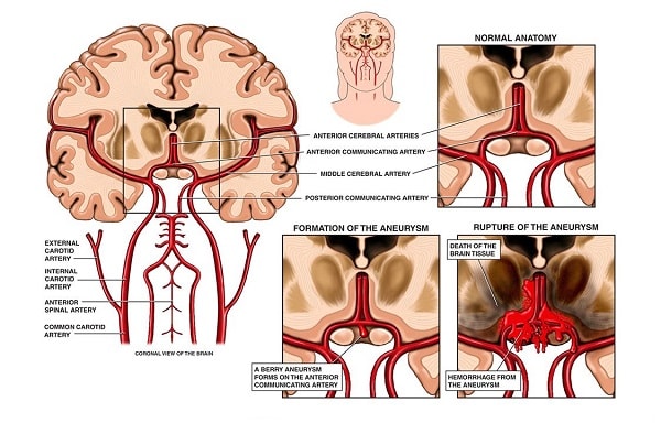 Nguyên nhân gây ra bệnh phình mạch máu não Nguyên nhân gây ra bệnh phình mạch máu não