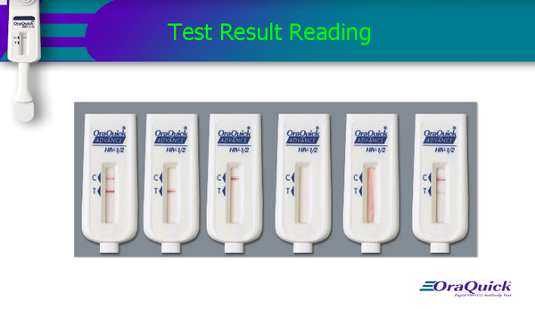 Xét nghiệm HIV bằng cách lấy dịch miệng Xét nghiệm HIV bằng cách lấy dịch miệng