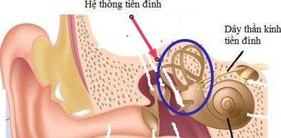 rối loạn tiền đình ở người cao tuổi