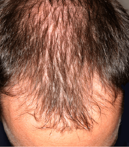 Nguyên nhân rụng tóc ở nam tuổi 20 và cách khắc phục
