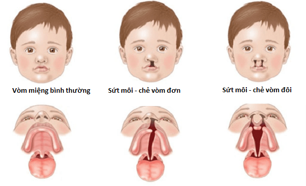 Biểu hiện của bệnh sứt môi chẻ vòm