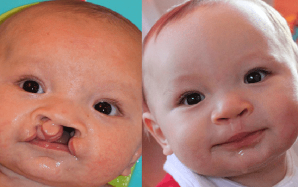 Kết quả điều trị sứt môi chẻ vòm