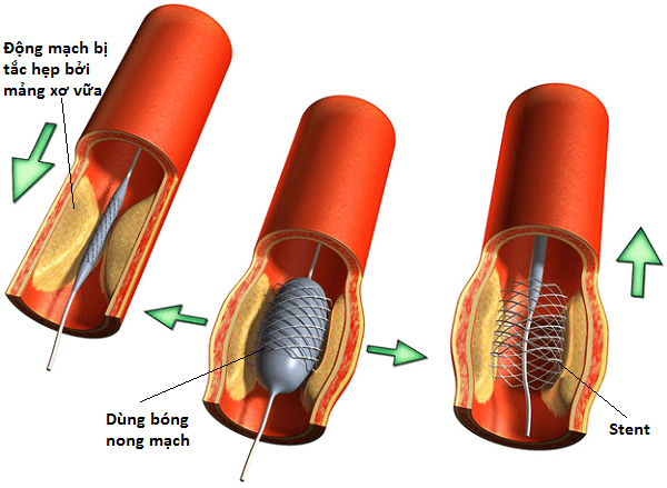 Phương pháp điều trị xâm lấn tối thiểu cho bệnh tắc nghẽn động mạch chủ - chậu