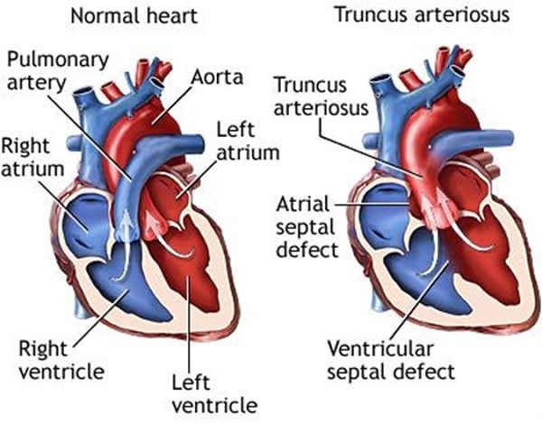 Hình ảnh tim bị thân chung động mạch