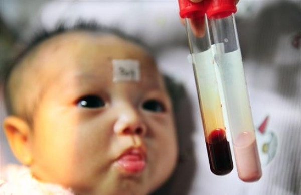 Bệnh thiếu máu Thalassemia ở trẻ nhỏ