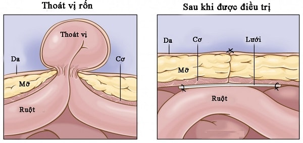 Điều trị bệnh thoát vị rốn Điều trị bệnh thoát vị rốn