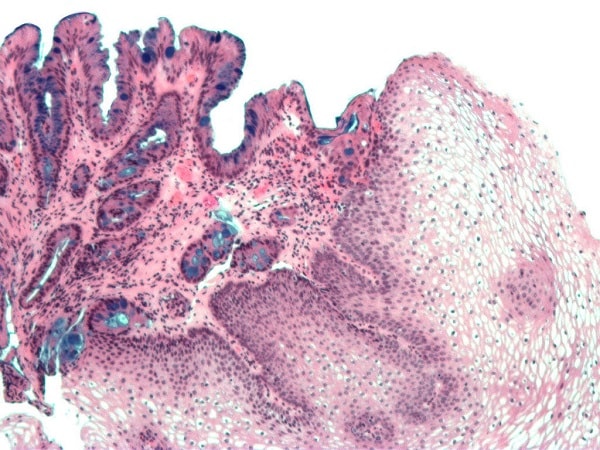 Hình ảnh thực quản Barrett