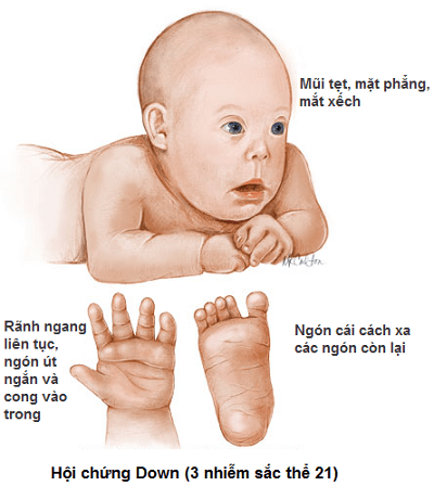 Những đặc điểm của trẻ bị bệnh Down
