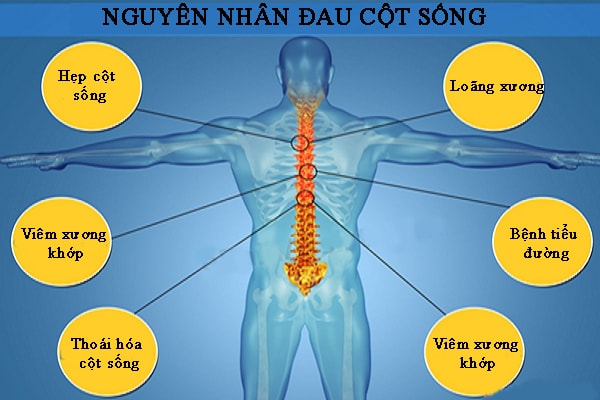 Nguyên nhân gây ra đau cột sống