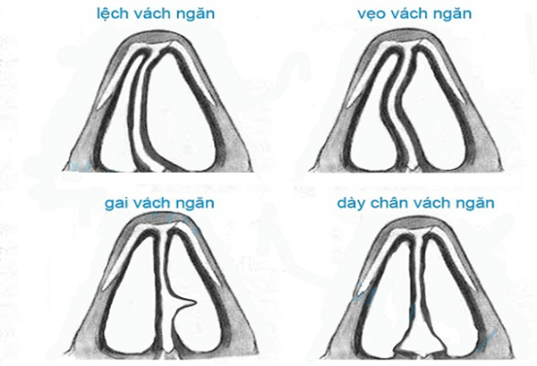 Bất thường vách ngăn mũi là nguyên nhân gây mất khứu giác