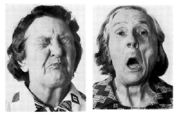 Biểu hiện của méo miệng