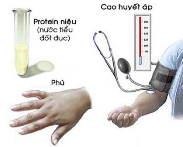 Triệu chứng Protein niệu