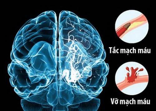 Tỷ lệ tai biến mạch máu não ở Việt Nam