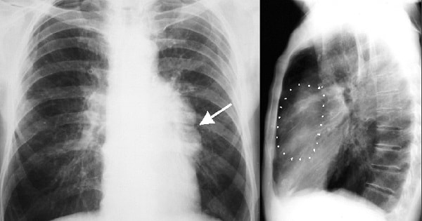 Hình ảnh chụp X-quang khối u trung thất