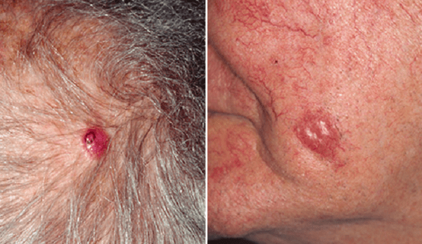 Ung thư tế bào Merkel