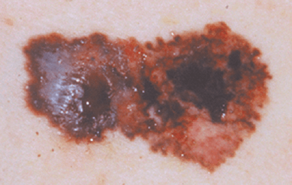 Dấu hiệu đầu tiên của ung thư tế bào sắc tố da