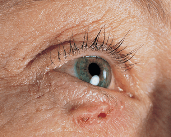 Ung thư tế bào đáy của da thường gặp ở mắt