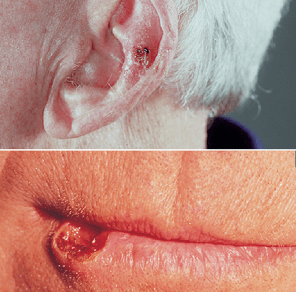 Ung thư tế bào gai ở da thường gặp ở môi, lỗ tai