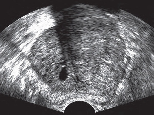 Điều trị ung thư tuyến tiền liệt