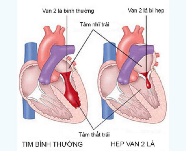 Nguyên nhân gây ra bệnh van 2 lá