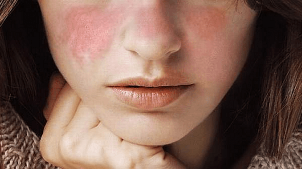 Nguyên nhân gây ra bệnh van 3 lá