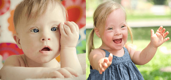 Những vấn đề về sức khỏe và y tế thường gặp ở người mắc bệnh Down