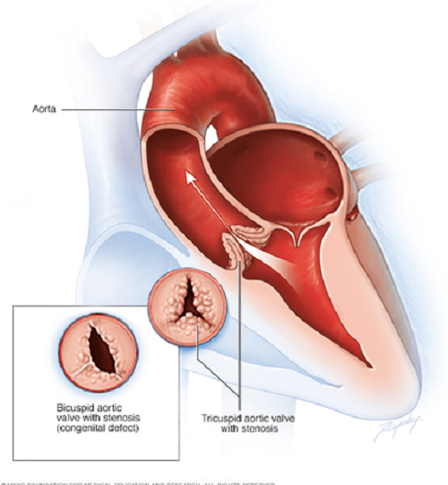 Nguyên nhân gây ra bệnh van tim