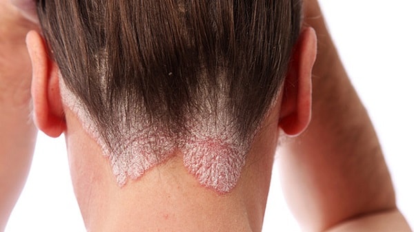 Vảy nến Psoriasis