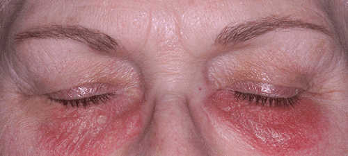 Viêm da tiếp xúc ở mặt