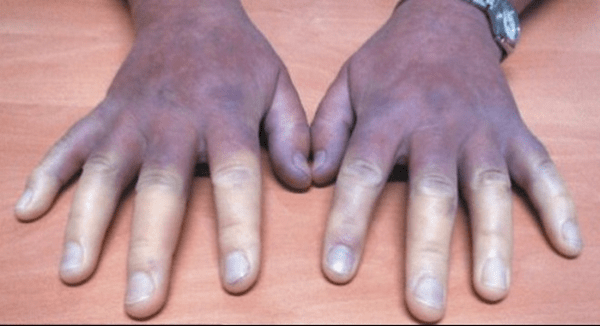 Biến chứng của bệnh xơ cứng bì