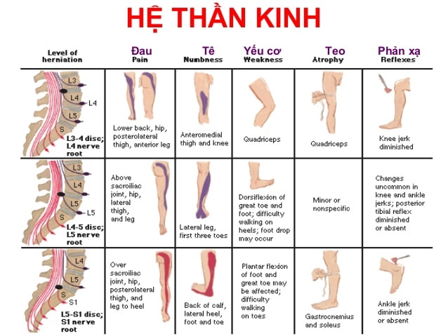 Phân biệt yếu cơ và teo cơ