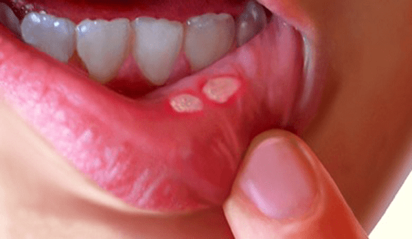 Loét miệng có nguy hiểm không, nguyên nhân, cách chữa trị