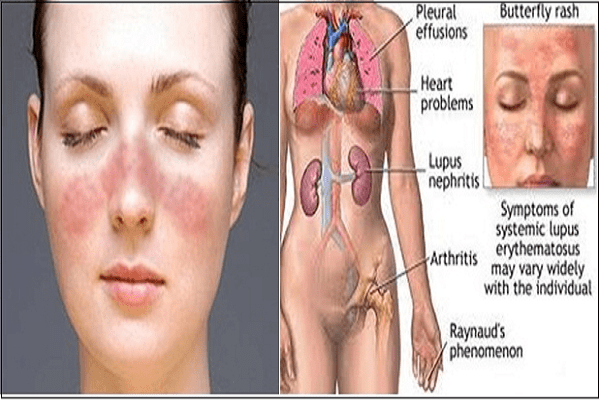 Lupus ban đỏ hệ thống là bệnh gì?
