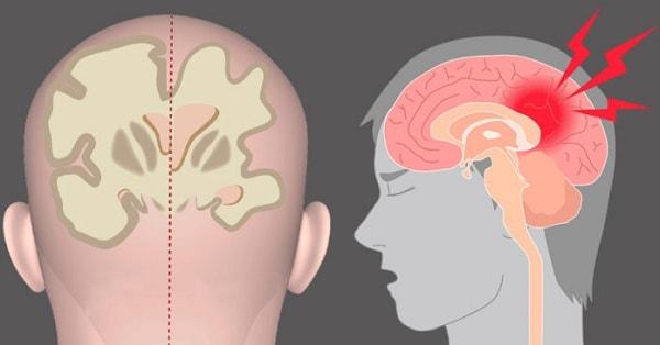Nên đi khám và điều trị bệnh teo não ở đâu?