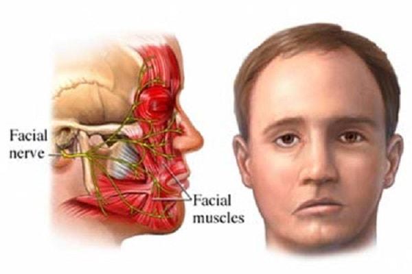 Nguyên nhân của bệnh đau dây thần kinh số V