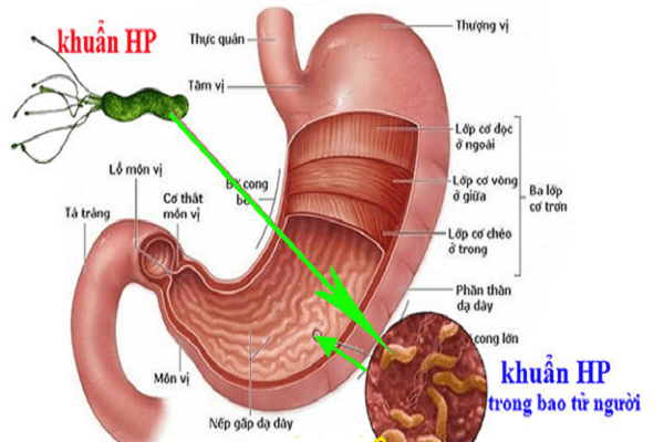 Nguyên nhân của bệnh nhiễm khuẩn Helicobacter Pylori 