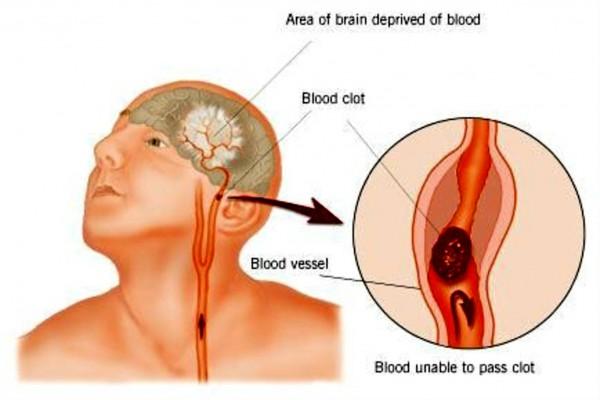 Nguyên nhân của bệnh tai biến mạch máu não là gì