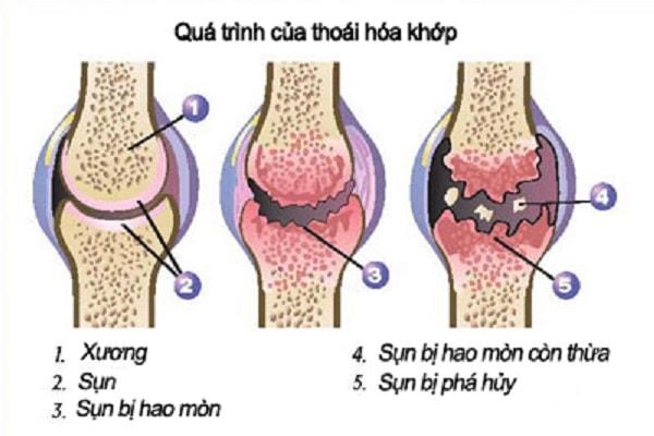 Nguyên nhân của bệnh thoái hóa khớp gối