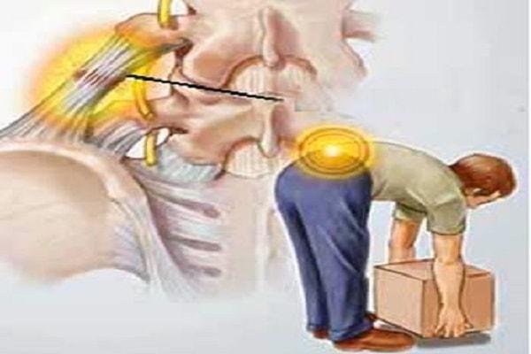 Nguyên nhân của bệnh thoát vị đĩa đệm cột sống thắt lưng