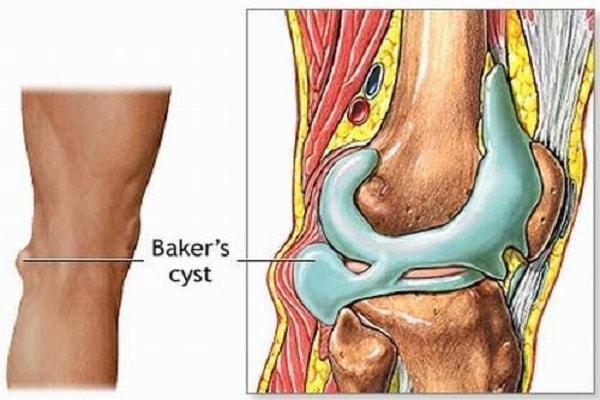 Nguyên nhân của bệnh tràn dịch khớp gối là gì