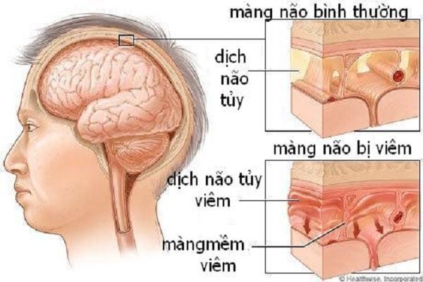 Nguyên nhân của bệnh u màng não