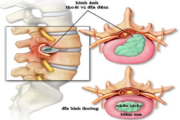 Nguyên nhân gây bệnh thoát vị đĩa đệm cột sống là gì