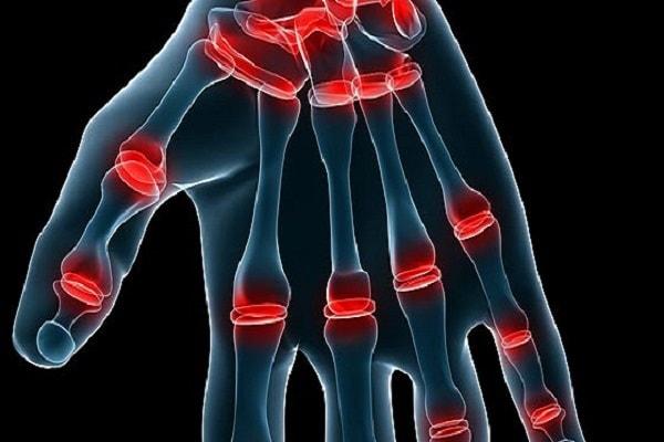 Nguyên nhân gây ra bệnh viêm khớp dạng thấp
