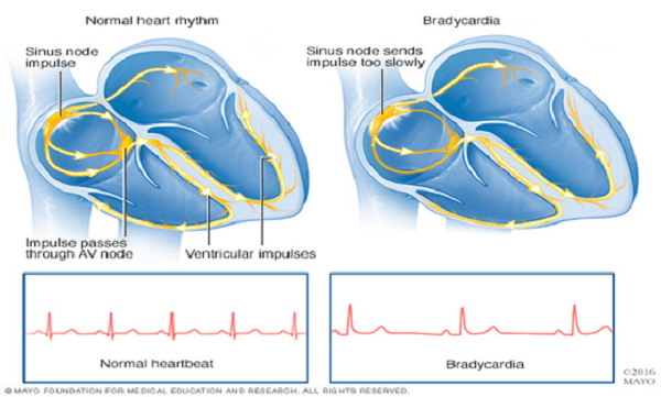 Nhịp tim chậm là tình trạng gì?

