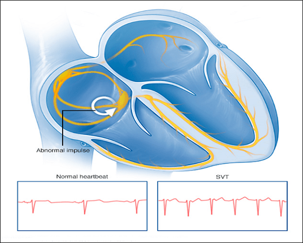 Trong y học, cách khác gọi tim đập nhanh là gì?

