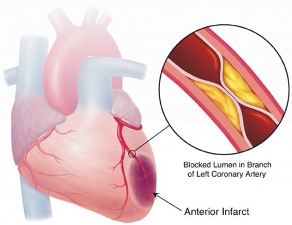 Nhồi máu cơ tim có nguyên nhân gì?
