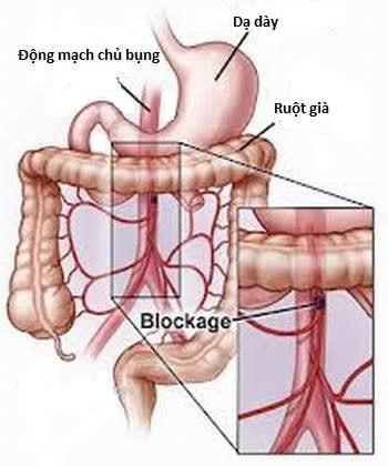 Nhồi máu mạc treo ruột