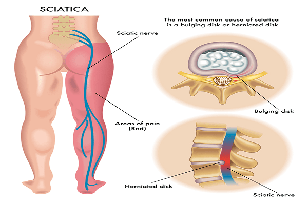 Những biến chứng của bệnh thoát vị cột sống thắt lưng