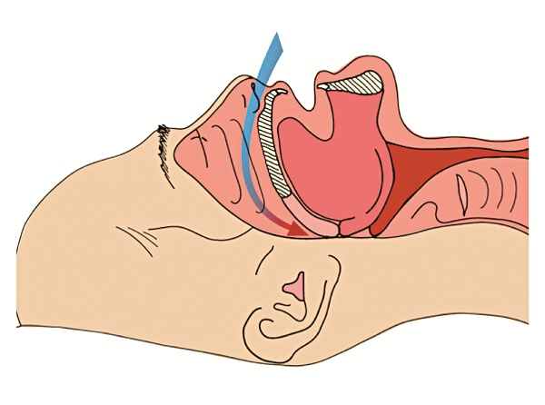 Những điều bạn cần biết về hội chứng ngưng thở khi ngủ